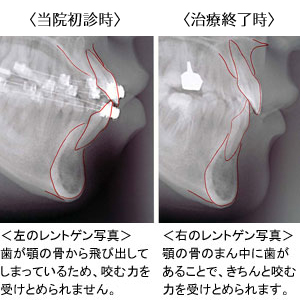 抜歯が必要なケース